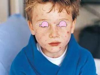 5岁儿童身上大片鸡皮疙瘩