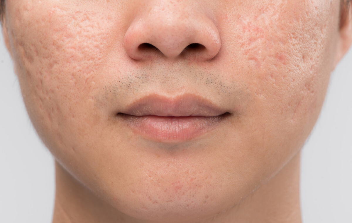 "痘坑"怎样修复,能否选择无恢复期的治疗项目?