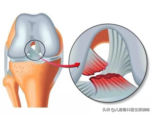 nba哪些球星韧带断裂(nba某球星左膝十字韧带撕裂，运动中要学会保护自己)