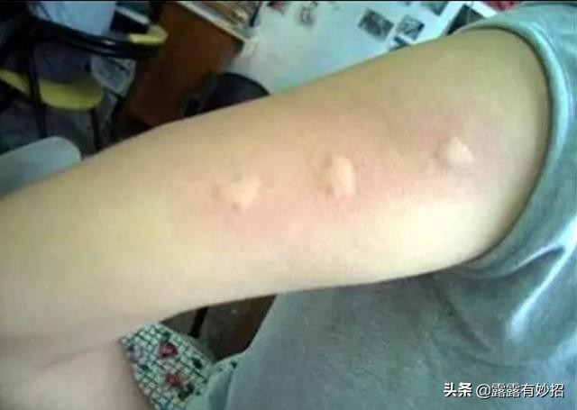 被蚊虫叮咬后瘙痒难耐，蚊子咬了怎么消肿止痒最快？
