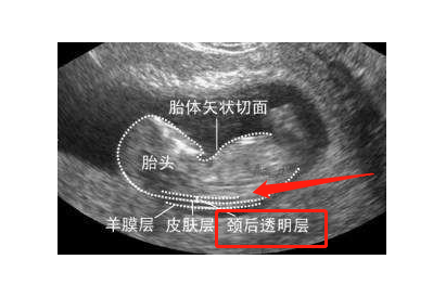 一分钟让你了解nt筛查