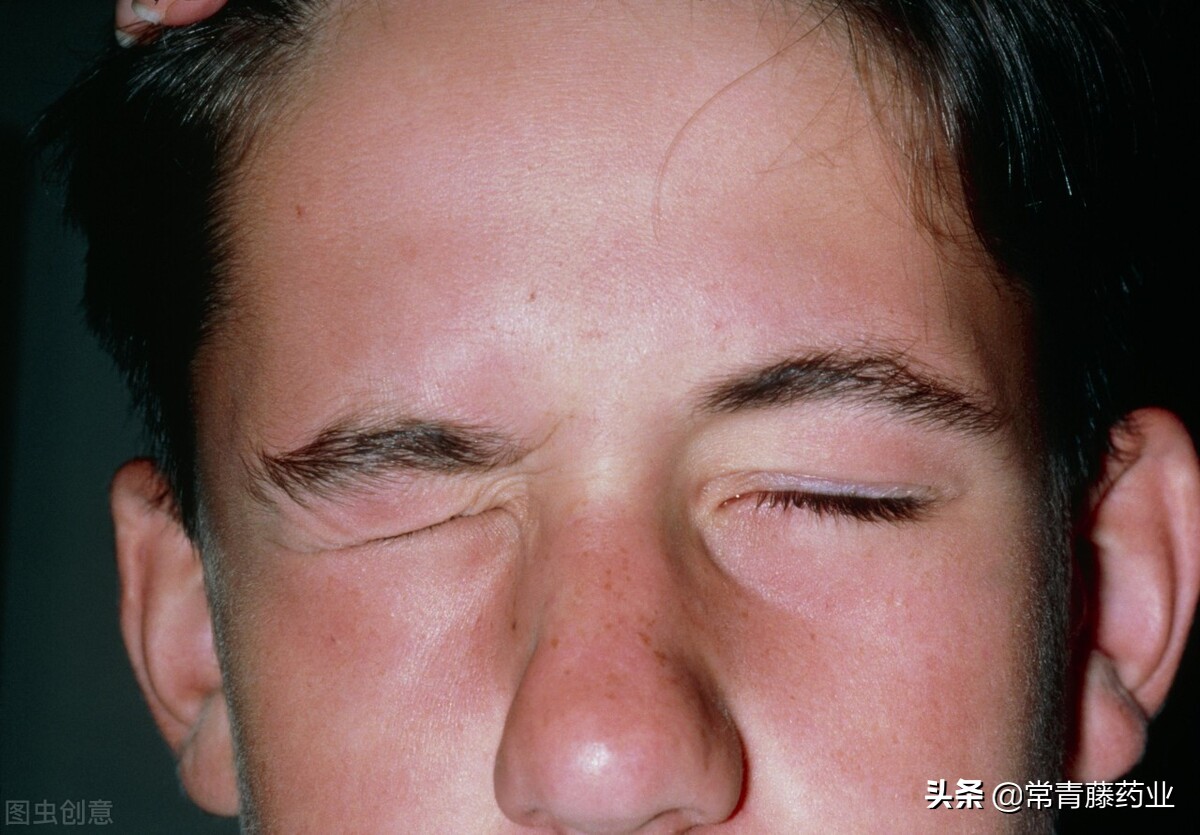 1,永久性听力损失和面部虚弱对于与亨特氏综合征相关症状,听力损失和