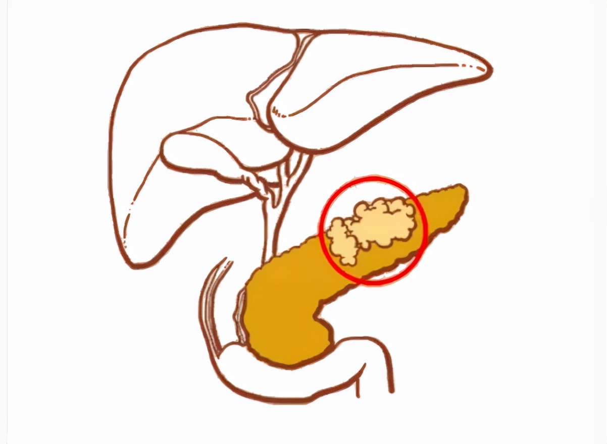 急性胰腺炎凶险万分,出现这些"求救信号",立马找医生