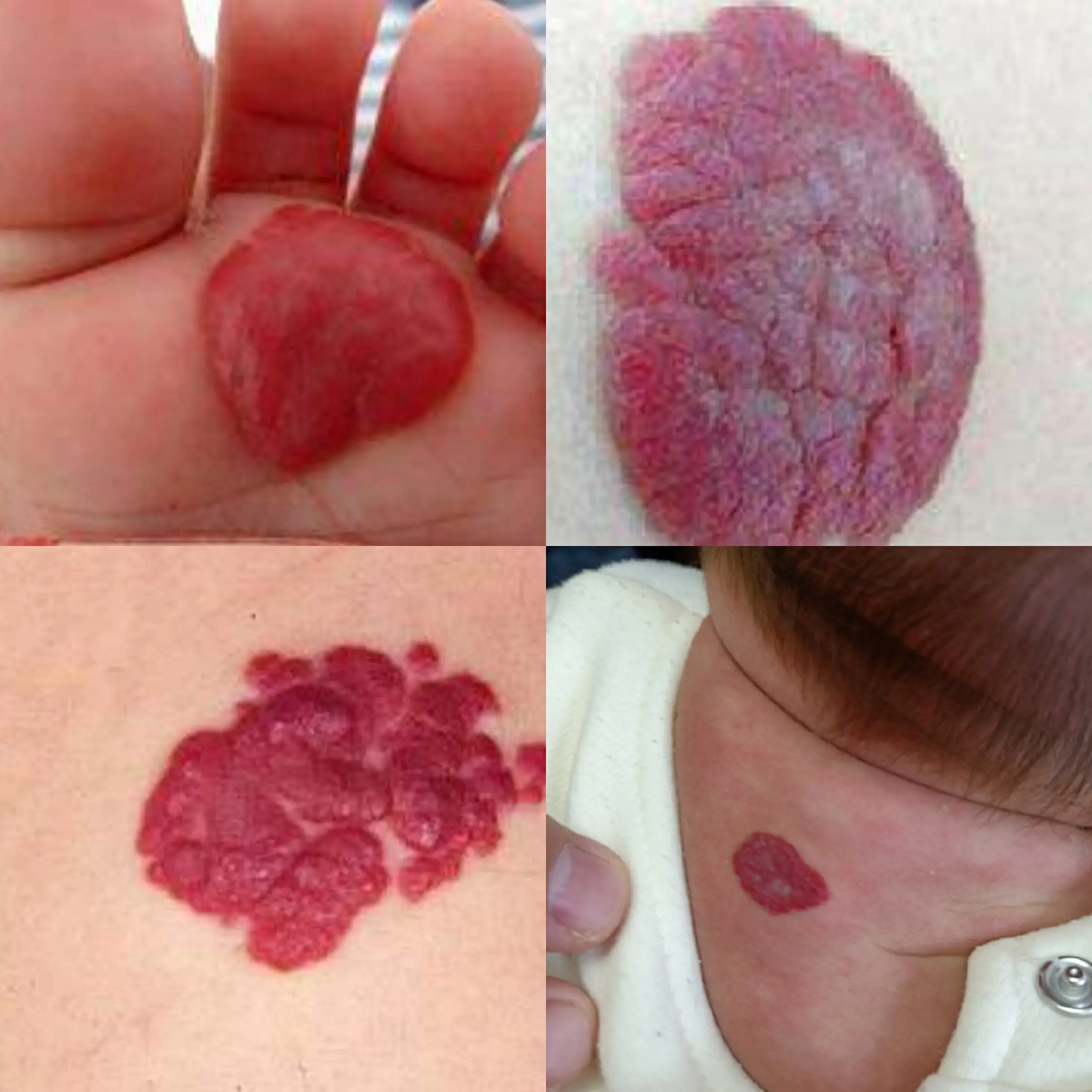 五种血管瘤图片图片