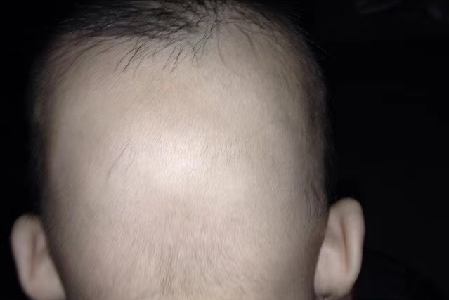 ②身体不适时,会频繁地摇头缓解不适,加大了枕秃的现象;③缺钙或缺乏